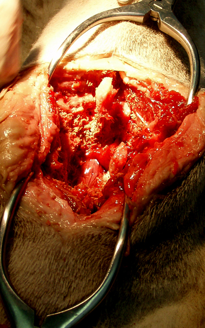 Traitement chirurgical de la hernie discale thoraco-lombaire