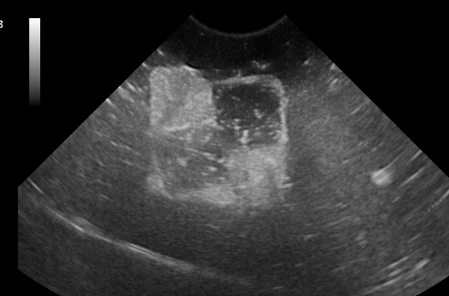 Formation ECHOINT1 : Echographie: ponctions, biopsies, prélèvements échoguidés /TP sur fantômes