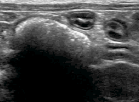 Formation EAN2-STML : Echographie abdominale normale : Partie 2 - surrénales, noeuds lymphatiques, tube digestif, pancréas, vascularisation.