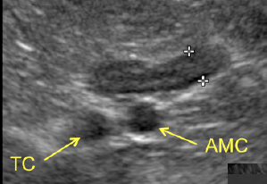 Formation EAN2-STML : Echographie abdominale normale : Partie 2 - surrénales, noeuds lymphatiques, tube digestif, pancréas, vascularisation.