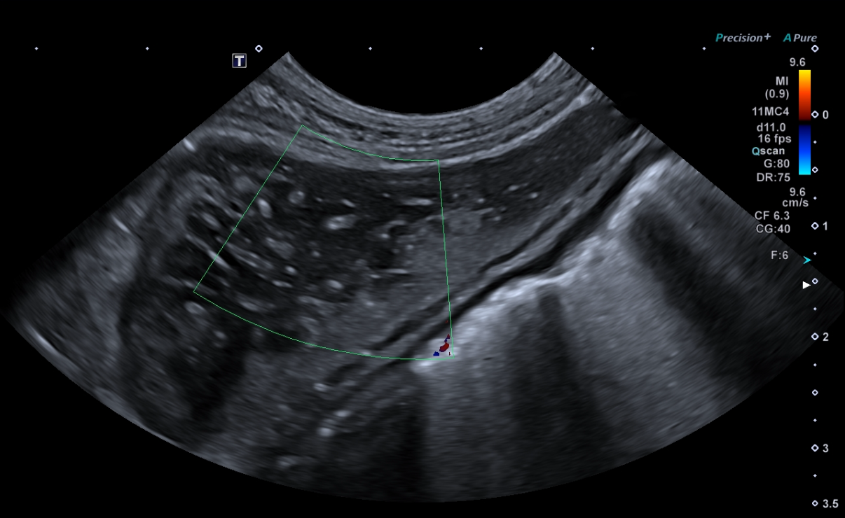 Formation EAP1 : Echographie abdominale pathologique : Foie - Rate.