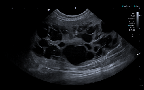 Formation EAP2 : Echographie abdominale pathologique - appareil urinaire, appareil génital Formation EAP2 : Echographie abdominale pathologique - appareil urinaire, appareil génital