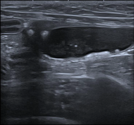Formation EAP2 : Echographie abdominale pathologique - appareil urinaire, appareil génital Formation EAP2 : Echographie abdominale pathologique - appareil urinaire, appareil génital
