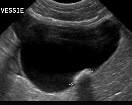 Formation EAP2 : Echographie abdominale pathologique - appareil urinaire, appareil génital Formation EAP2 : Echographie abdominale pathologique - appareil urinaire, appareil génital