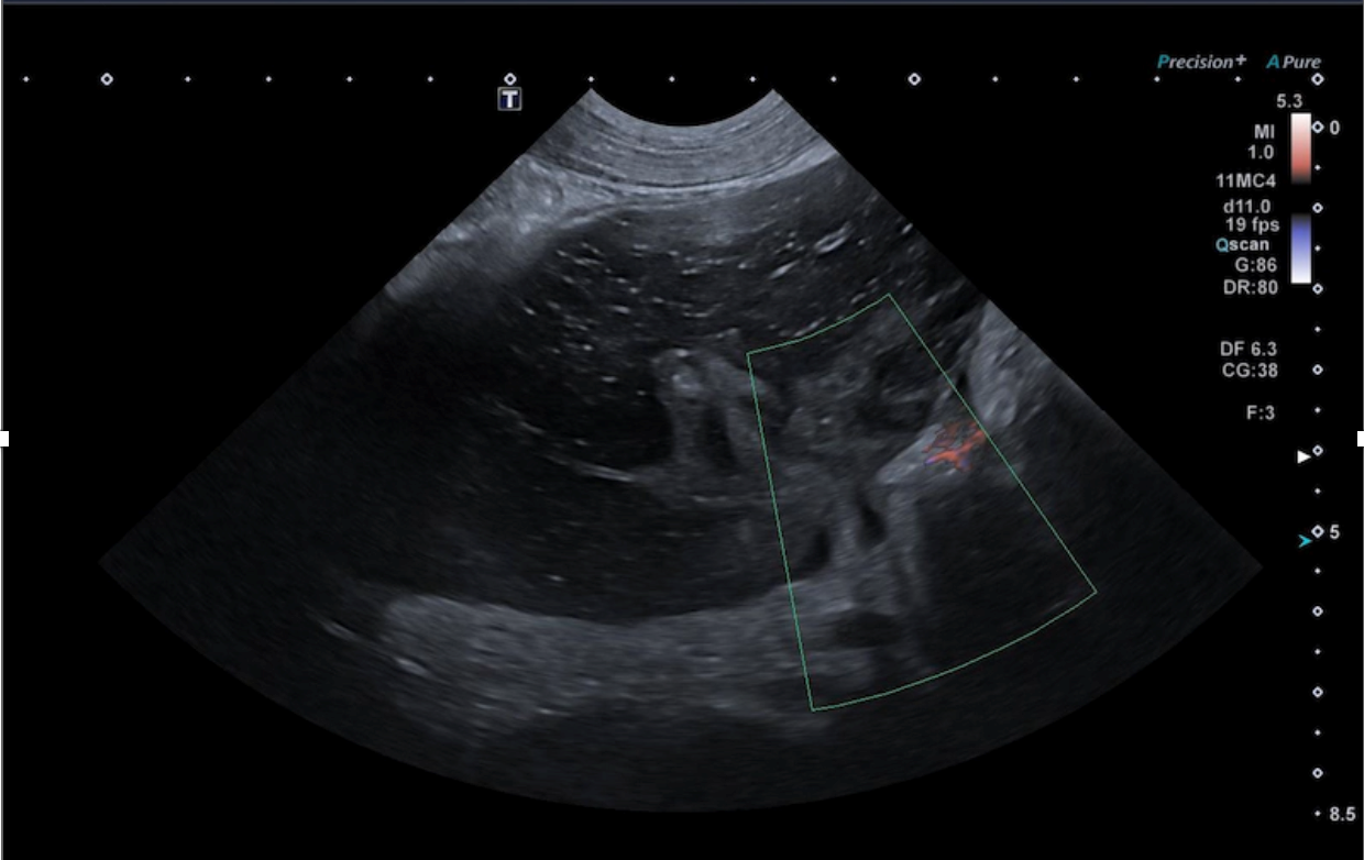 Formation EAP3 : Echographie abdominale pathologique : Tube digestif, pancréas et surrénales Formation EAP3 : Echographie abdominale pathologique : Tube digestif, pancréas et surrénales
