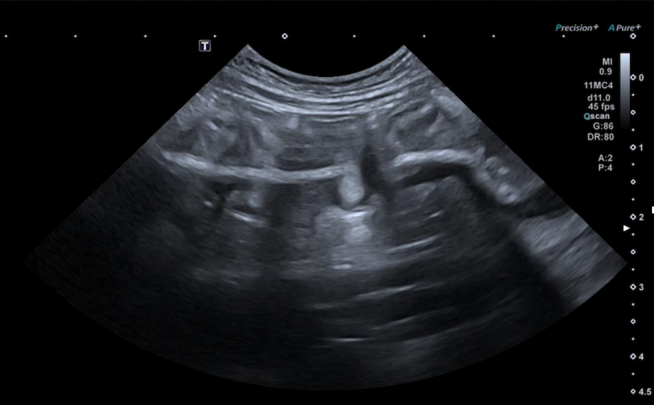Formation EAP3 : Echographie abdominale pathologique : Tube digestif, pancréas et surrénales Formation EAP3 : Echographie abdominale pathologique : Tube digestif, pancréas et surrénales