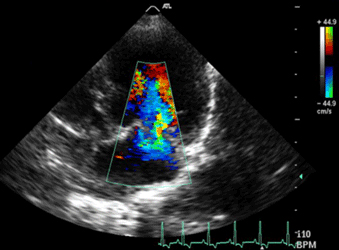 Formation EC002 : Echographie Doppler cardiaque : aspect normal