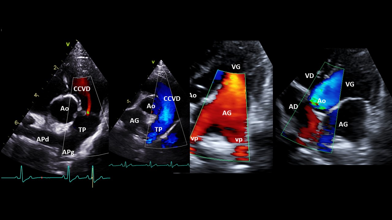 Formation EC003B : Echographie Doppler cardiaque : aspect normal