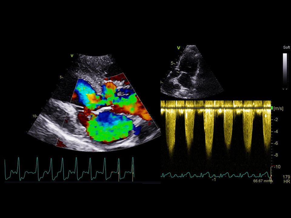 Formation EC004 : Echographie Doppler cardiaque : aspects lésionnels (cas cliniques)